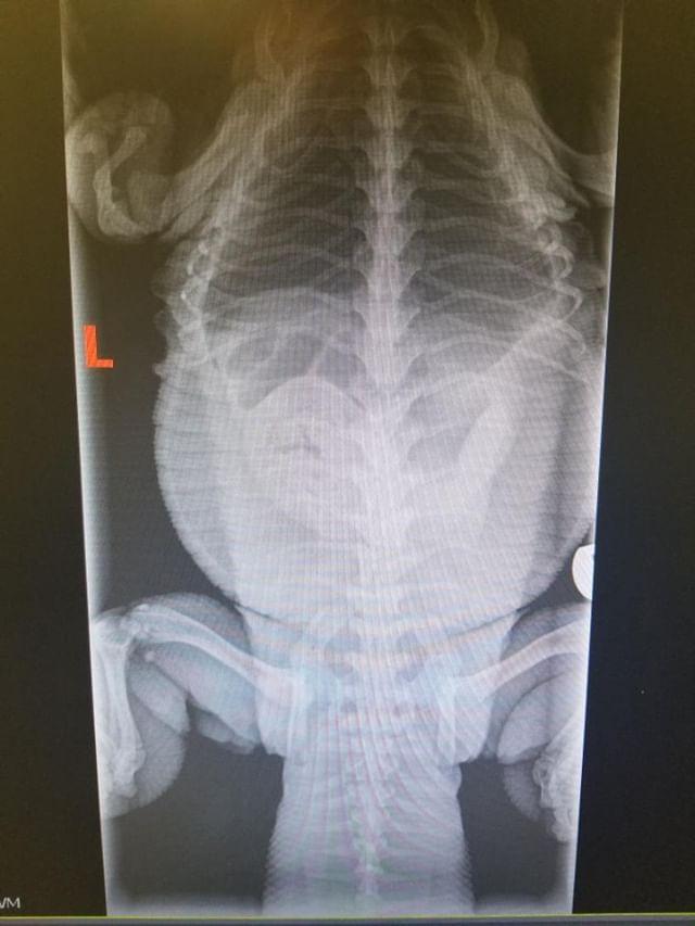 Upset intestinal tract